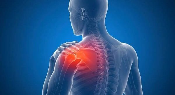 Frozen Shoulder